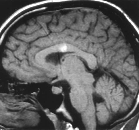 Lesions of the Corpus Callosum: MR Imaging and Differential ...