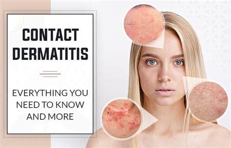 Contact Dermatitis: Everything You Need to Know and More | Winston Salem Dermatology