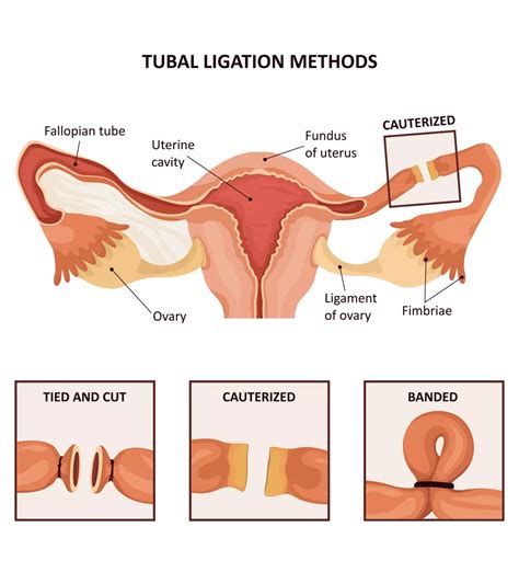 Tubal Ligation: What It Is, Procedure, Benefits And Risks