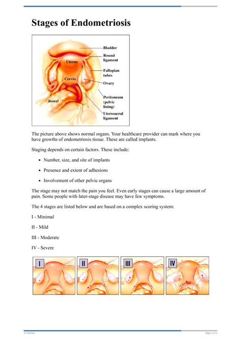 Text - Stages of Endometriosis - HealthClips Online