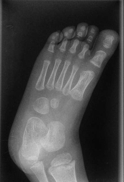 Normal Foot Xray Child