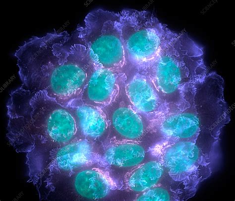 Breast cancer cells, light micrograph - Stock Image - M122/0418 - Science Photo Library