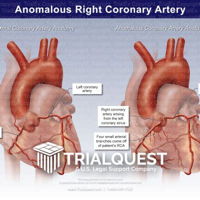 Anomalous Right Coronary Artery - TrialExhibits Inc.