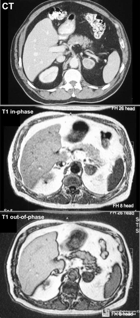 Learning Radiology Adrenal Adenoma Adrenal Glands, Adrenals, New ...