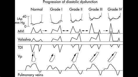 DIASTOLIC DYSFUCTION & GRADES - YouTube