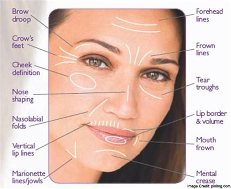 Nasolabial Folds: Causes, Symptoms, Treatment and Prevention | Face fillers, Nasolabial folds ...
