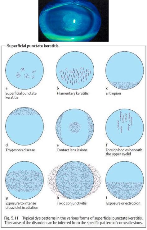 Superficial Punctate Keratitis - Eye Disorders - StudyPK