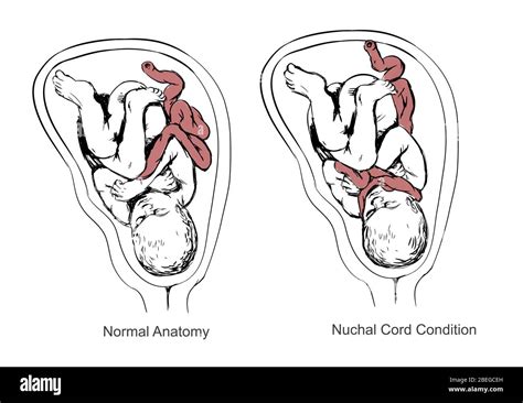 Nuchal cord hi-res stock photography and images - Alamy