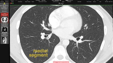 Pulmonary Artery Segmental Anatomy