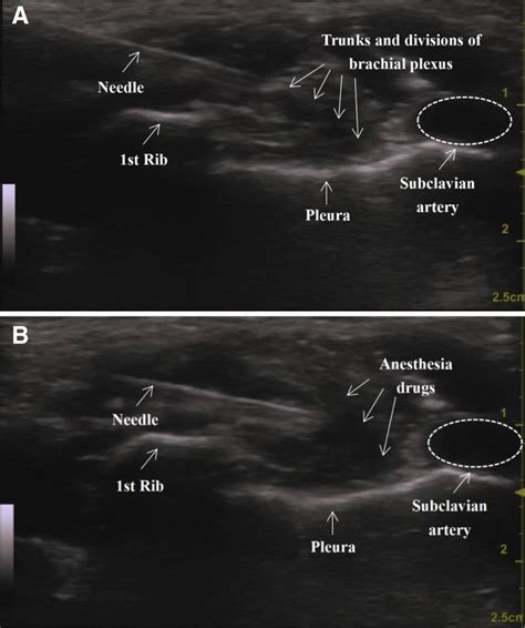 Ultrasound image of the supraclavicular approach before (A) and after... | Download Scientific ...