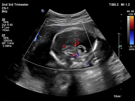 “Two Minds In One” -A Rare Case Of Intracranial Fetus In Fetu | Eurorad