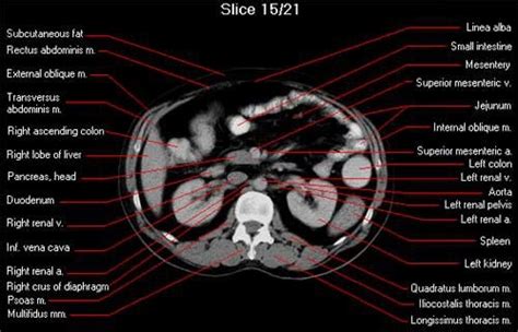 axial CT whole abdomen scan | Ct scan, Radiology imaging, Radiology