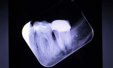 X-ray of Root Canal Infection for Precise Diagnosis - HSIN FILM