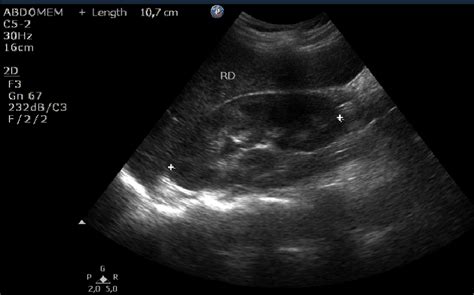 Abdominal ultrasound with heterogeneous contents in the uterine cavity ...