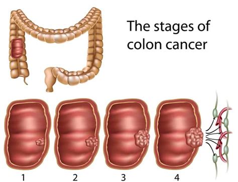 Difference Between a Colonoscopy & Cologuard | Gastroenterologist Near