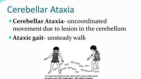 Sensory Ataxia