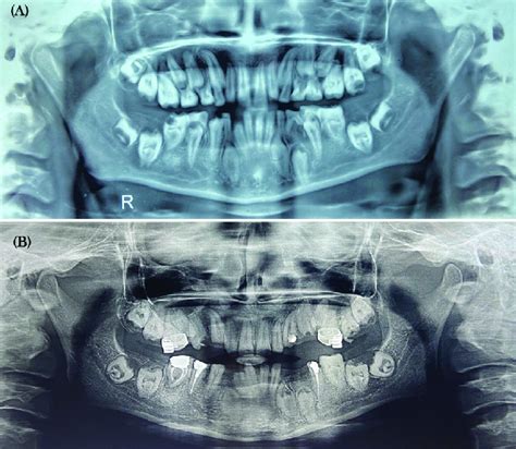 OPG before (A) and after (B) dental procedure. OPG, orthopantomogram ...