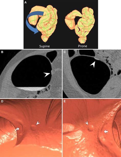 Cecal rotation in a 60-year-old female who has a sessile serrated polyp... | Download Scientific ...