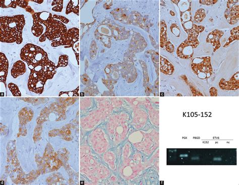 Primary cutaneous cribriform apocrine carcinoma: Case report and literature review - Indian ...