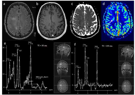 Gliomatosis cerebri. Conventional MRI: a, b Axial FLAIR and ...