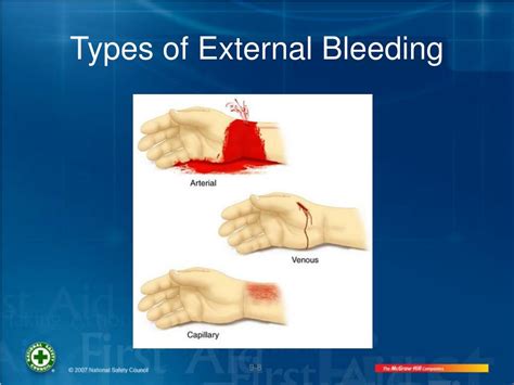 PPT - Controlling Bleeding PowerPoint Presentation - ID:669107