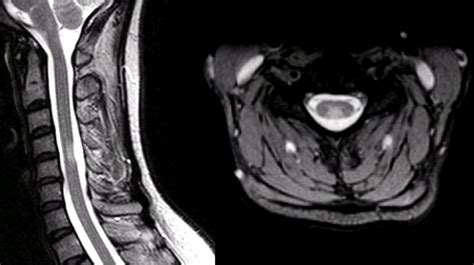 Transverse Myelitis Mri - The Radiology Assistant Myelopathy - Magnetic resonance imaging (mri ...