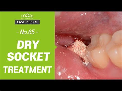 Dry Socket Treatment • Video • MEDtube.net