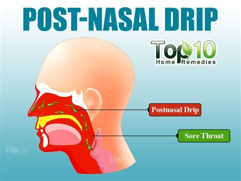 Illustration Showing Post Nasal Drip | Stuffy nose remedy, Post nasal drip remedy, Sinus remedies