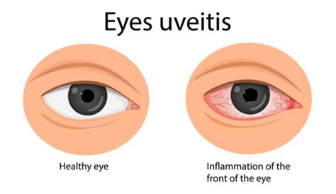 Uveitis Guide: Types, Symptoms, Causes, and Treatments | MyVision.org