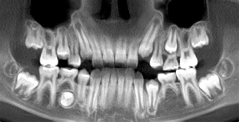 Picture | Panoramic radiograph, Orthodontics, Panoramic