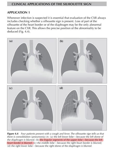 The Silhouette Sign 01 ... #Chest X ray | Silhouette sign, Radiology, Radiologist