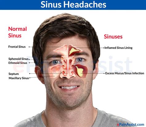 Chris McNeil Chiropractor Sinus Headache Releif | Sinus headache, Sinusitis, Migraine headaches ...