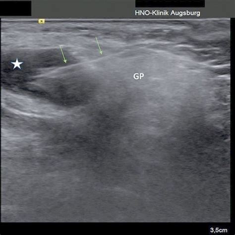 Ultrasound-guided core needle biopsy of a parotid tumor. Representative ...