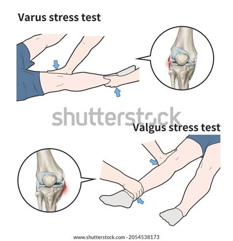 Varus valgus stress test를 설명하는 3d 스톡 일러스트 2054538173 | Shutterstock