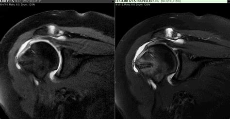 MRI Shoulder Scan | Greater Waterbury Imaging Center