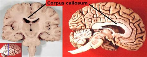 Corpus callosum function | General center | SteadyHealth.com