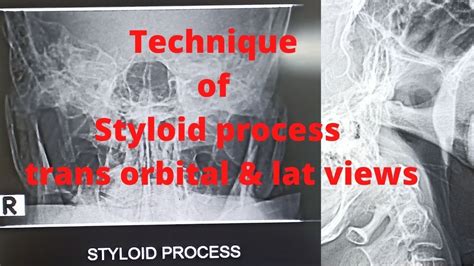 Styloid Process X Ray