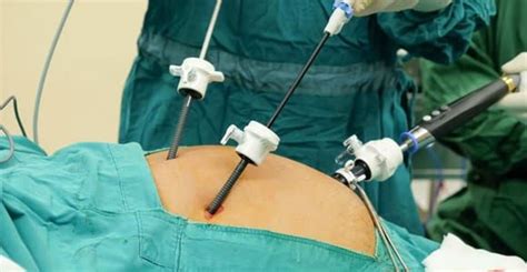 Laparoscopic Gallbladder Stone Operation: 5 Simple tips to follow for a faster recovery ...