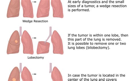 Lung Cancer Surgery - MEDICINE FOR WORLD