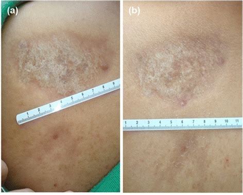 Morphea (Localized Scleroderma) — Symptoms and Prognosis | Lecturio