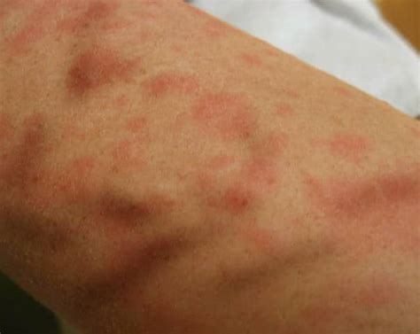 Itchy Skin Rash - Pictures, Causes, Symptoms, Treatment - HubPages