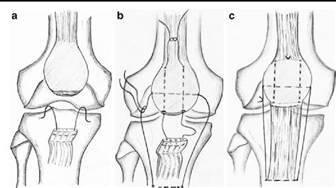 Patellar Tendon Rupture Repair