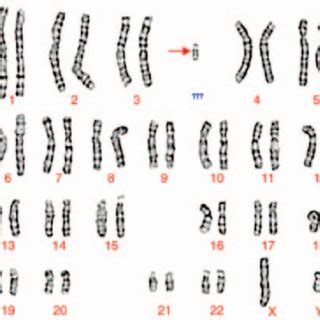 The mosaic karyotype of the patient identified by GTG banding technique... | Download Scientific ...