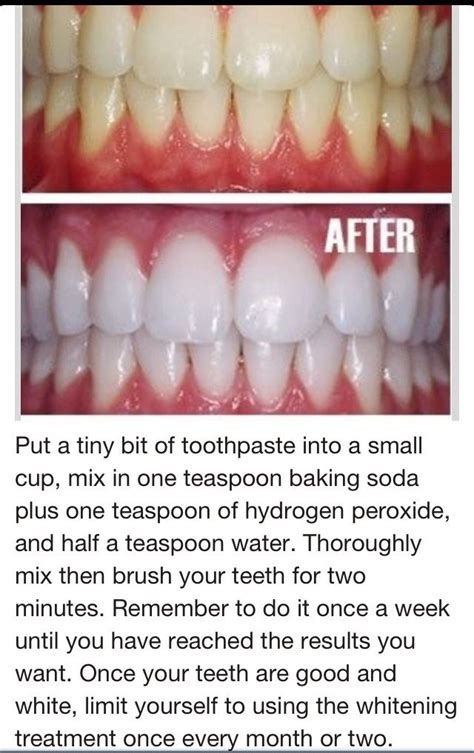 Hydrogen Peroxide Baking Soda Teeth Whitening Before After