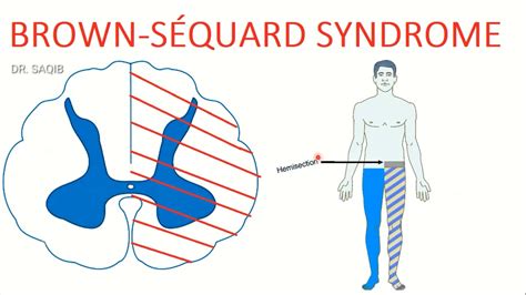 Brown-séquard syndrome | Hemisection of the spinal cord - YouTube