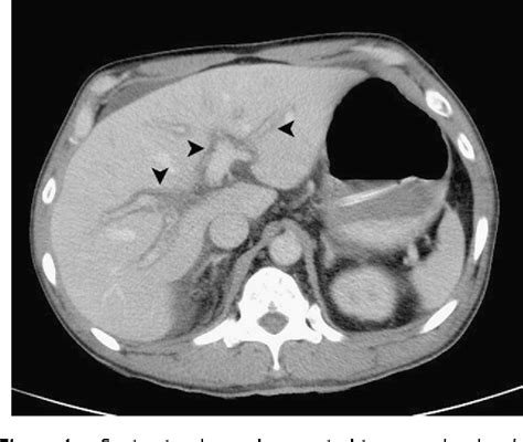 Figure 1 from Periportal edema after cardiac arrest due to calcium channel blocker overdose ...