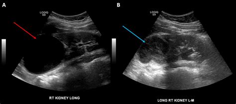 Frontiers | Percutaneous endoscopic creation of a neoinfundibulum for a ...