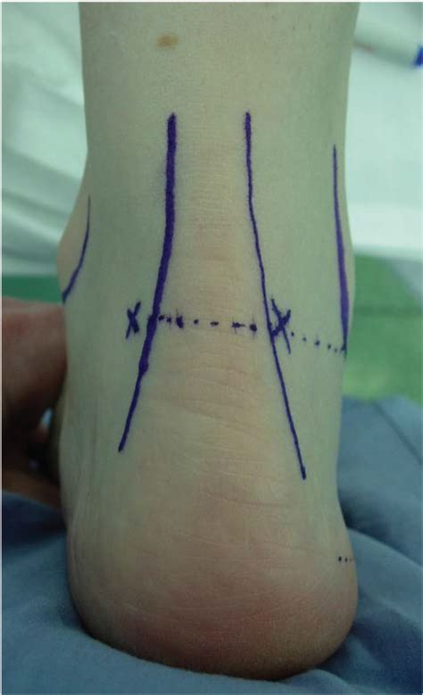 Posterior Ankle Arthroscopy | Musculoskeletal Key