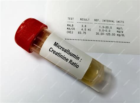 Premium Photo | Urine Sample for Urine ACR or microalbumin creatinine Ratio for Chronic kidney ...