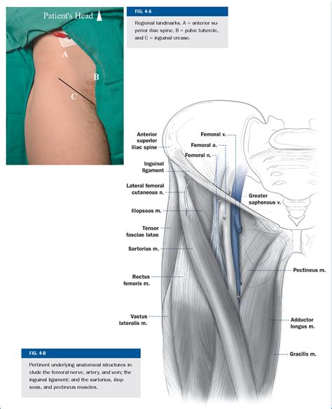 Figure 2 from Femoral nerve block for diaphyseal and distal femoral fractures in the emergency ...